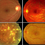 Retinopatía diabética.