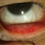 Conjuntivitis