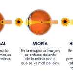 Miopía. Hipermetropía. Astigmatismo.